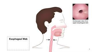 EGD-Colon-Entero-Lesson 2f3-Pathology of Esophagus-Web