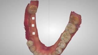 Digitally Guided Dental Implant Placement with Osseodensification and Guided Bone Regeneration