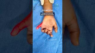 Congenital Anomaly Polydactyl Correction | Birth Defects | Dr. Manoj Bachhav