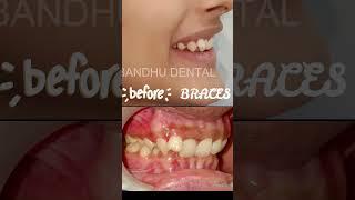 Another Smile Delivered with Braces 16.07.2023 #braces #bestdentistindelhi #teeth