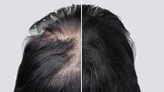 A revolutionary approach to combating hair loss / Peter Petrovich Garyaev / the science / Minoxidil