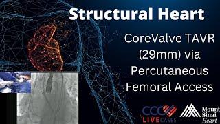 CoreValve TAVR (29mm) via Percutaneous Femoral Access Structural Heart Live Cases - April 2015