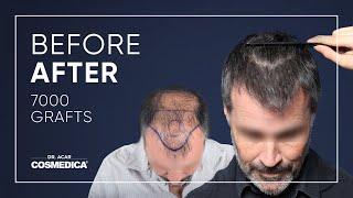 Hair Transplant in Turkey | Results | Dr. Acar | Cosmedica Clinic