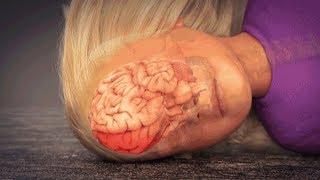 Coup-Contrecoup Brain Injury Animation