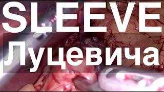 как Луцевич делает Sleeve резекцию желудка // лапароскопическая резекция желудка