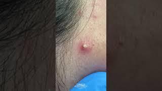 #shorts Pimple Popping by Dermatologist Dr. Timothy Jochen | CONTOUR DERMATOLOGY