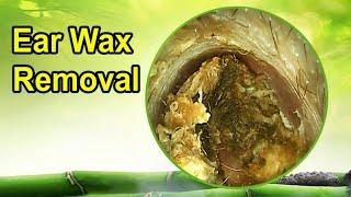 Best relaxing video earwax removal