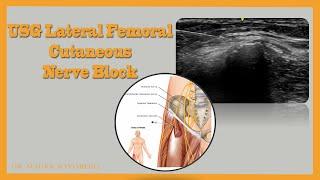 USG Lateral Femoral Cutaneous Nerve Block