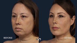 Female Facial Rejuvenation | Before and After | Dr. David Stoker