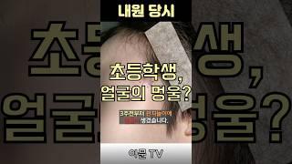 초등학생 얼굴 관자놀이 근처 멍울 핀홀법 수술 치료 후기 [아문TV]