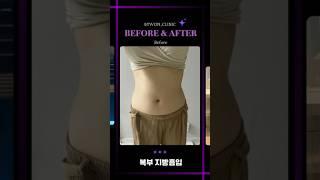 복부 지방흡입 리얼후기 #복부지흡