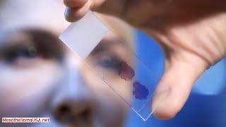 INTRAPLEURAL CHEMOTHERAPY MESOTHELIOMA