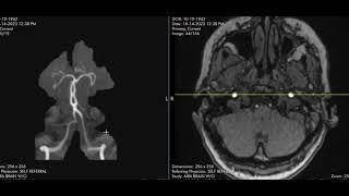 Basilar artery fenestration