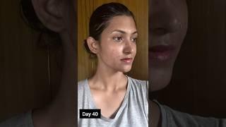 My acne journey #acnescars #acnepositivity #acnetreatment