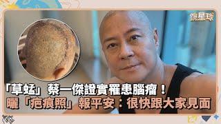 「草蜢」蔡一傑證實罹患腦瘤！　曬「疤痕照」報平安：很快跟大家見面｜鏡速報 #鏡新聞