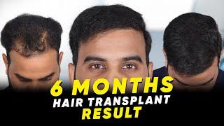 Hair Transplant in Salem | Best Results & Cost of Hair Transplant in Salem