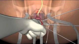 Pelvic Floor Repair - Urology Animation