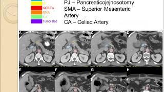 Pancreas Cancer and Radiation