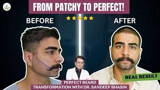 Beard Transplant Success Story | Happy Patient’s Journey at Care Well Medical Centre