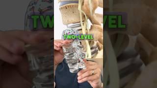 Lumbar Disc Replacements Shown in Action