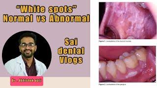 WHITE SPOTS NORMAL VS ABNORMAL