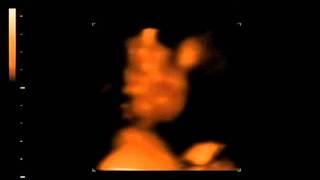 Haise Baby Zero 3D Ultrasound