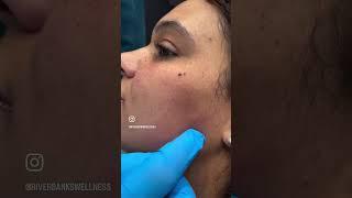 Profhilo Treatment in action