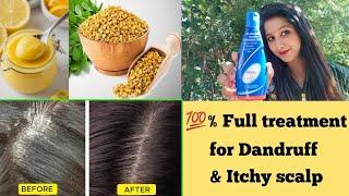 dandruff treatment at home/dandruff kaise hataye/dandruff removal at home/itchy scalp home remedy