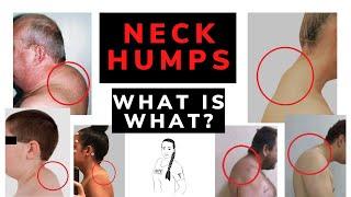 Neck hump - dowager's hump or buffalo hump? What is what?!