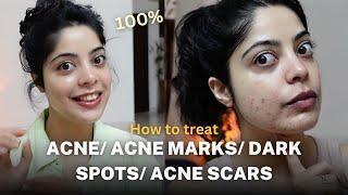 How I get rid of Acne, Acne Spots & Dark Spots ? Products that ACTUALLY WORKS