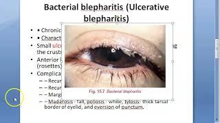 Ophthalmology 371 a Blepharitis Eye Lid Margin Inflammation Swelling Bacterial Ulcerative