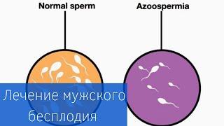 МУЖСКОЕ БЕСПЛОДИЕ | Азооспермия: диагностика и лечение