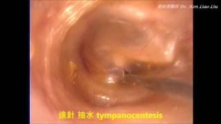 門診光纖內視鏡中耳炎中耳積水細針抽水 OPD FIBERSCOPIC TYMPANOCENTESIS FOR  OME / MEE