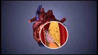 Atherosclerosis - 3D Animation || ABP ©