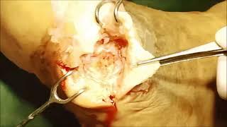 Diabetic Foot Ulcer Surgery | Ulcer Treatment, Diabetic Foot Treatment in Valsad, Bharuch, Surat
