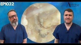 Removing a FUNGAL INFECTION from someone's EAR CANAL - EP1032