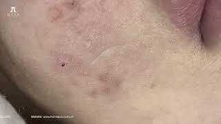 Big Cystic Acne Blackheads Extraction Blackheads & Milia, Whiteheads Removal Pimple Popping