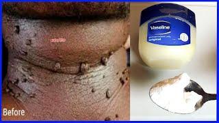 How to remove skin tags in one night naturally at home best skin tag removal vaseline