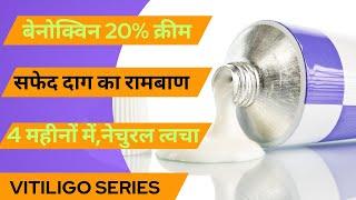 Benoquine Cream-सफेद दाग का सस्ता इलाज||मात्र 4 महीने में सफेद दाग की छुट्टी|| #Vitiligo #सफेद_दाग