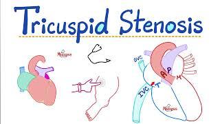 Tricuspid Stenosis (TS) - Valvular Heart Disease (VHD) - Tricuspid valve stenosis - Cardiology 🫀