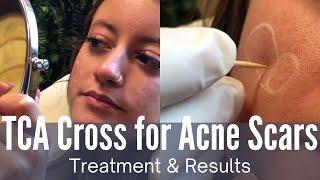 #TCA Cross: The Best Treatment for Ice Pick Acne Scars | Full Treatment & Before and After Photos