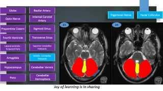 MRI Brain Sectional Anatomy Cut 13 & 14