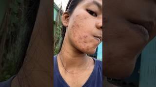 My acne treatment journey #shorts #pimplecare #skincare #skincareroutine #acnetreatment