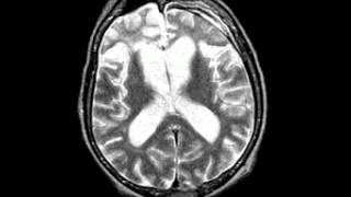 Degenerative Disease Picks disease