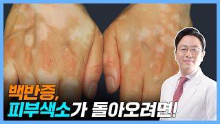 백반증! 피부색소 되돌리는법 [vitiligo]