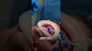 Результат в конце видео #стоматология #стоматологиямосква #зубы #виниры #винирымосква