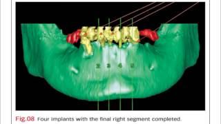 Bench mastery: Complete implant maxillary and mandibular reconstruction