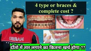 दाँतो में तार लगाने का खर्च ! Braces 4 types and cost |