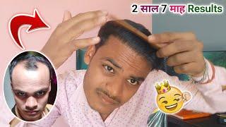 FUE Hair Transplant Results Before And After Hair Style Boys | Hair Transplant Raipur & Bhopal City