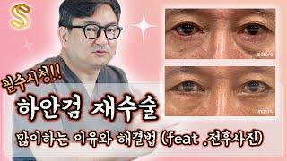 실패한 하안검수술 , 하안검재수술로 안검외반 없애고 효과볼수 있습니다. (feat. 전후사진) ( #눈성형 눈재수술 유명한 병원)